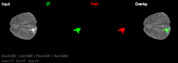Brain Tumor Segmentation on the Edge figure